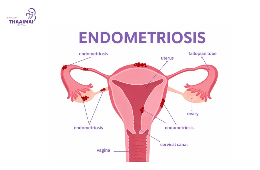 Causes of Female Infertility